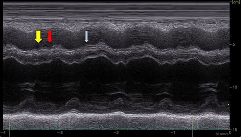 is paradoxical septal motion dangerous